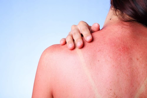 Sunburned-Skin